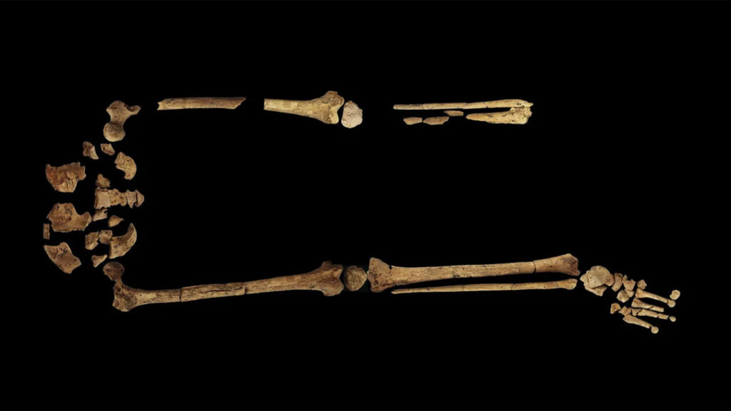 ancient surgery with borneo amputation 31,000 years ago