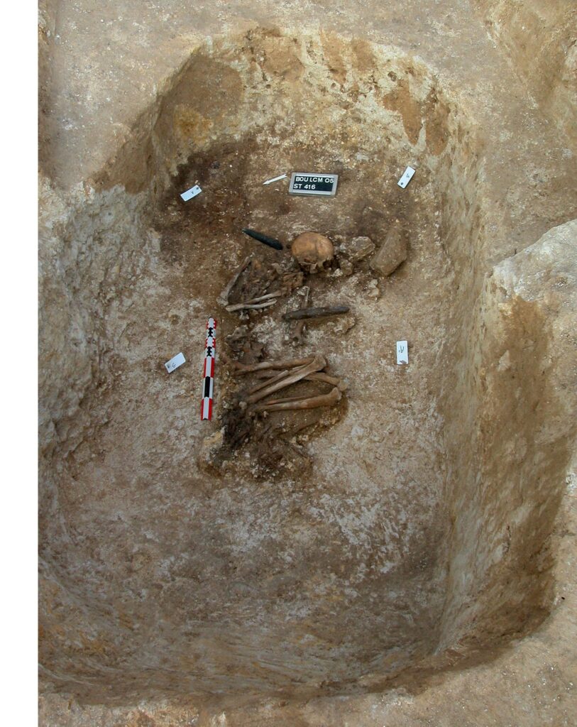 French neolithic burial of a man with his arm amputated